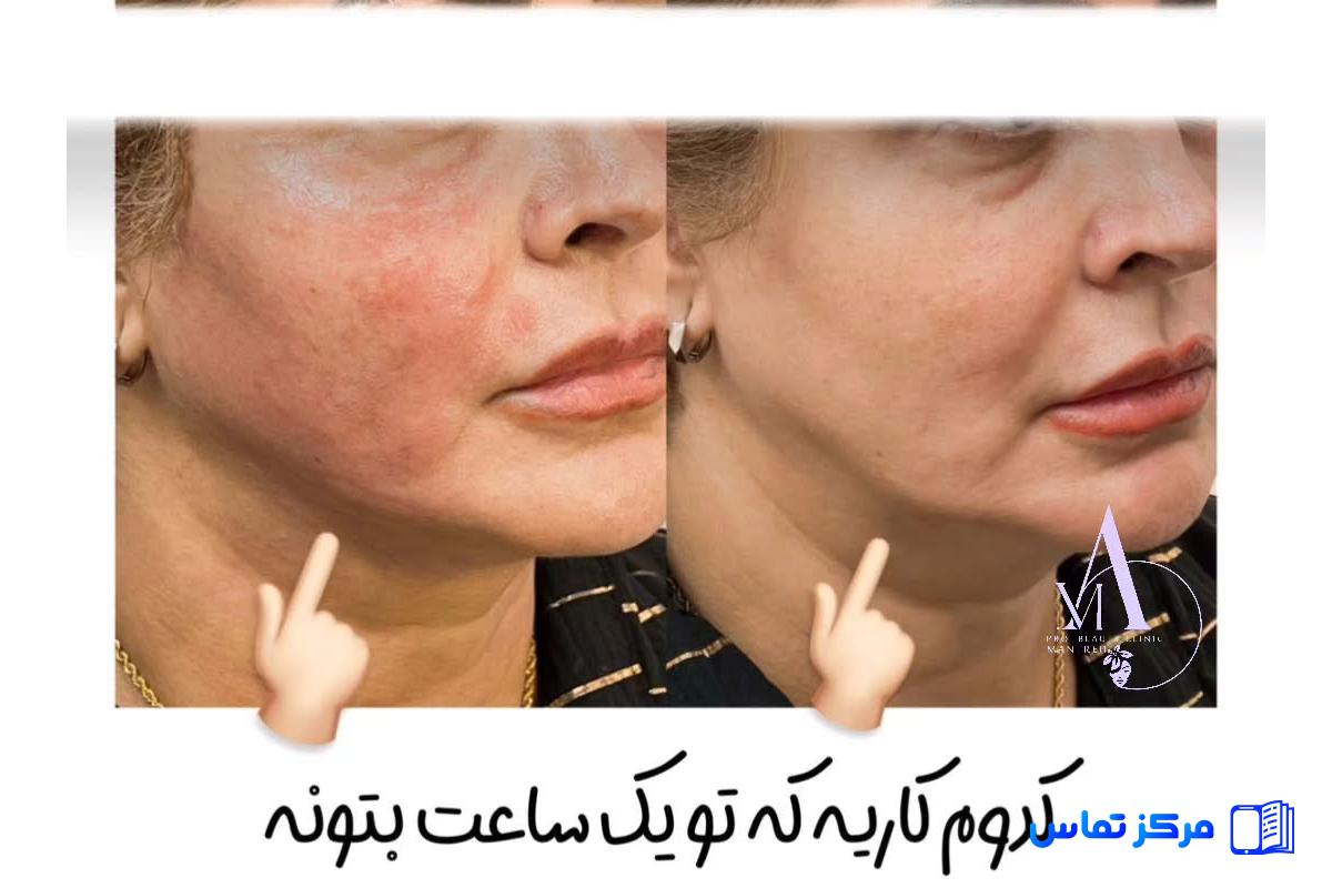 بهترین خدمات هایفو تراپی در ایران شهر تهران منطقه الهیه