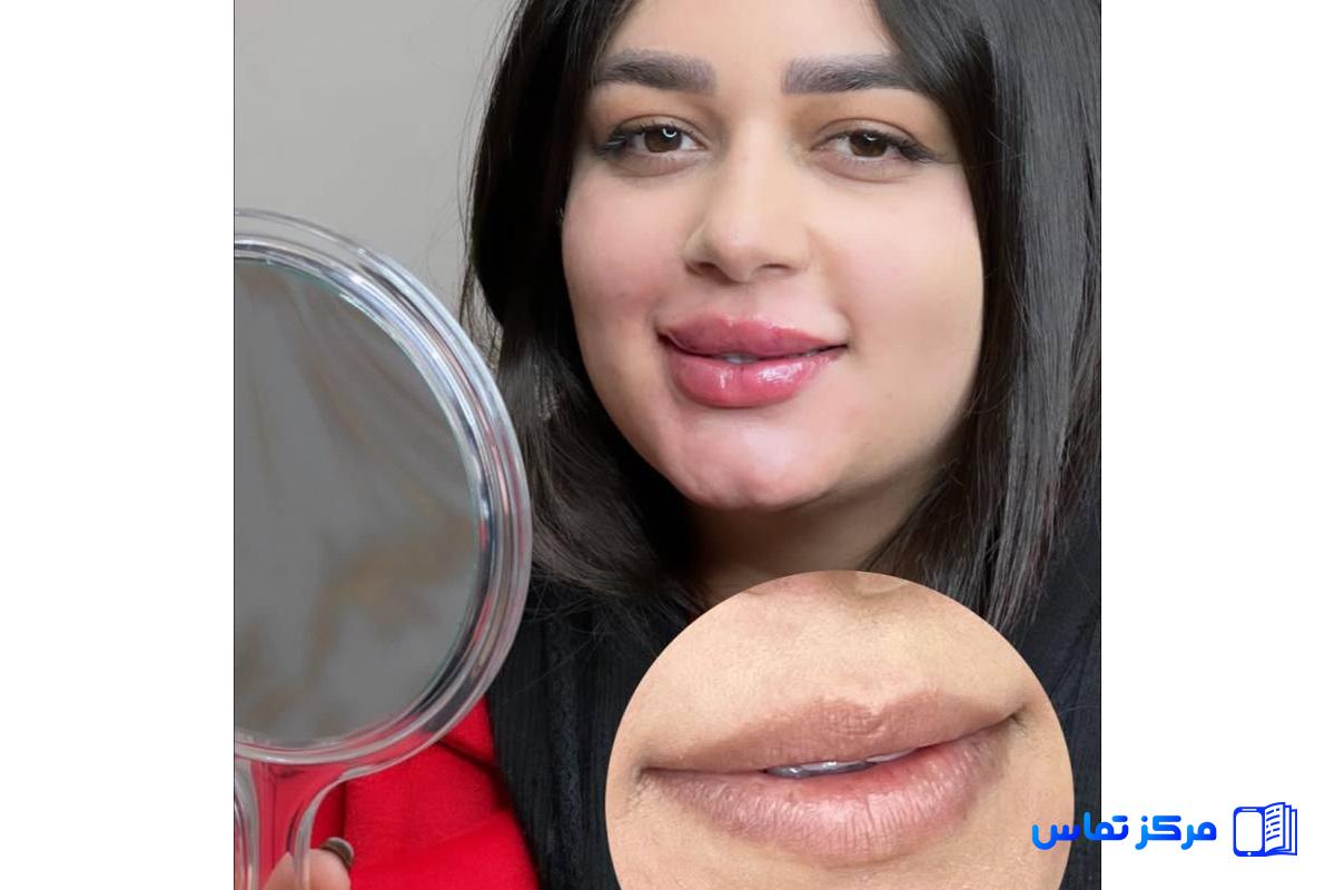 بهترین خدمات فیلر در ایران شهر تهران منطقه الهیه