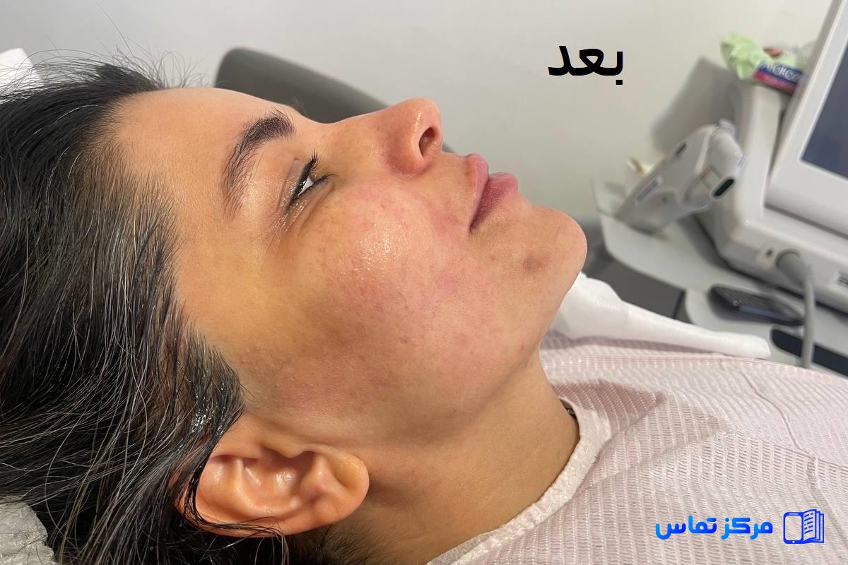 بهترین هایفوتراپی و لیزر در شهر تهران
