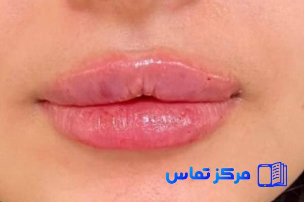 بهترین کلینیک فیلر بینی، لب، چانه، خط خنده، صورت، گونه در تهران